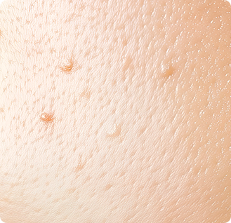 폐쇄 면포(화이트헤드)