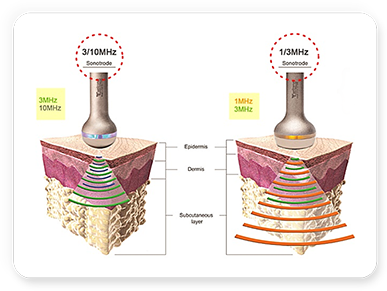 LDM 시술 원리 다이어그램