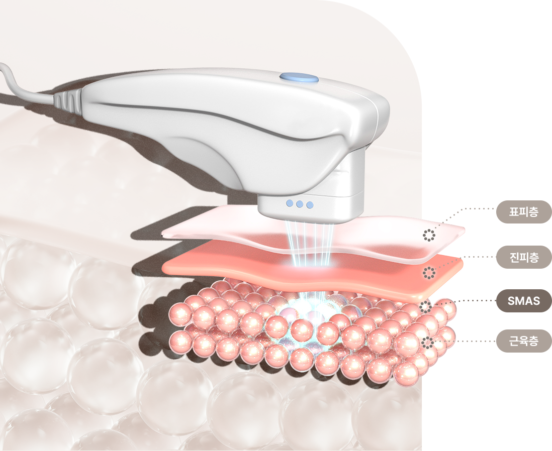 SMAS 장비 이미지