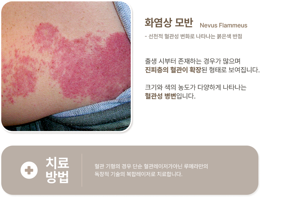 화염상 모반 이미지