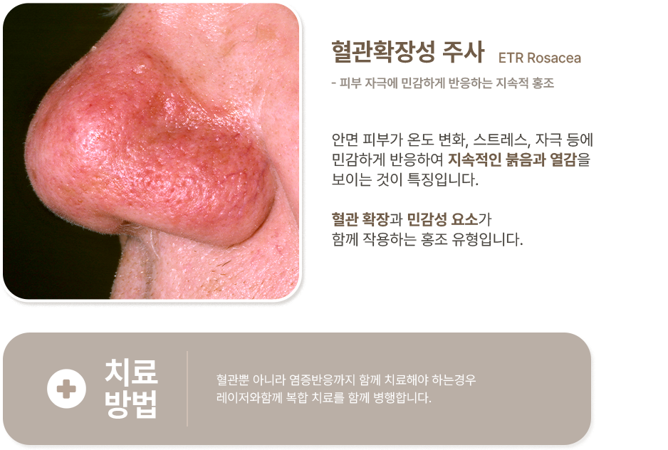 혈관확장성 주사 이미지